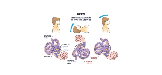 Závrať typu benigní paroxysmální polohové vertigo (BPPV) – příznaky, příčiny a léčba