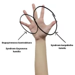 Bolest dlaně a prstů - příčiny